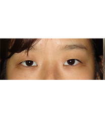 韩国CNMcoanmi外科整形双眼皮手术案例对比图