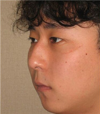 韩国CNMcoanmi外科整形驼峰鼻整形对比案例_术前