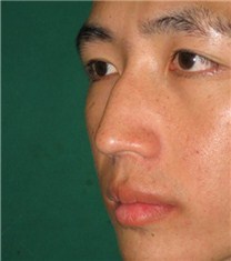韩国可安美（CNM）整形外科鹰钩鼻修复对比图