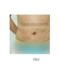 韩国JL郑胜文整形外科-韩国JL郑胜文整形外科腰腹吸脂对比图