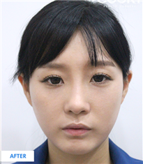 韩国COOKI整形医院-韩国COOKI整形医院双眼皮埋线法对比图