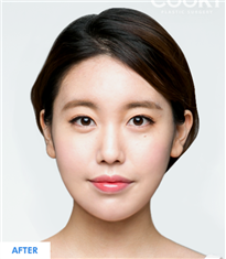 韩国COOKI整形医院-COOKI整形医院下颌角整形对比案例图