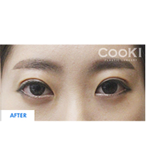 韩国COOKI整形医院-韩国COOKI整形医院双眼皮切开法案例图