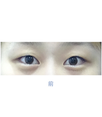 韩国高恩世上整形外科-韩国德丽珍整形外科双眼皮埋线案例对比图