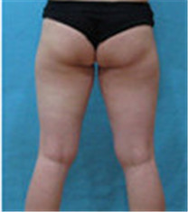 美人整形外科医院-大腿吸脂对比案例