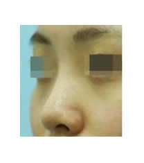 韩国ARUMP LINE整形外科隆鼻整形对比图