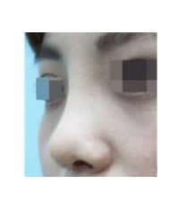 韩国ARUMP LINE整形外科隆鼻整形对比图_术后