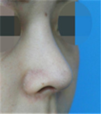 cocoa整形外科-隆鼻对比案例