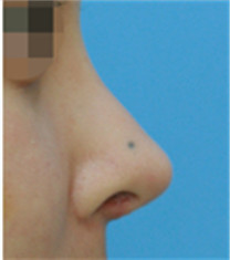 cocoa整形外科-自体软骨隆鼻对比案例