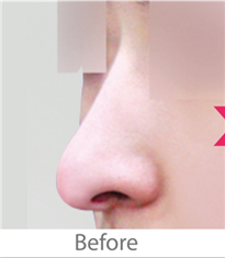 韩国德丽珍整形外科鹰钩鼻矫正案例对比图