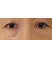 韩国德莱茵医院双眼皮案例对比图​