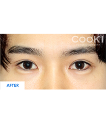 韩国COOKI整形医院-韩国COOKI整形医院双眼皮对比图