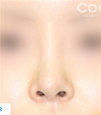韩国COOKI整形医院鼻翼缩小手术图