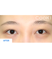 韩国COOKI整形医院-韩国COOKI整形医院双眼皮修复图