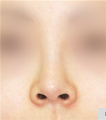 韩国COOKI整形医院鼻翼缩小手术图