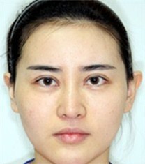 韩国COOKI整形医院-COOKI整形医院下颌角对比图