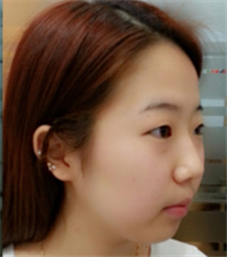 韩国COOKI整形医院-COOKI整形医院脸颊吸脂、双眼皮对比图