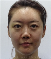 韩国德丽珍整形外科鼻子修复对比图_术前