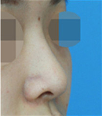 cocoa整形外科-隆鼻对比案例