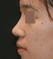 韩国金在中整形外科假体隆鼻对比图