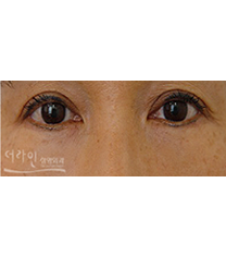 韩国德莱茵医院双眼皮日记对比图​