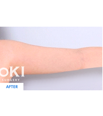韩国COOKI整形医院手臂吸脂术案例图