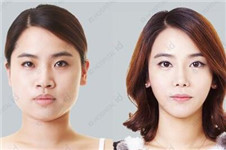 ID与face line做面部轮廓效果对比