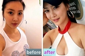 韩国UcanB和爱琳整形医院假体隆胸多少钱，哪家效果好？