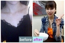 在韩国原辰整形医院做假体隆胸，唯一的美中不足你造吗？