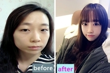分享我在韩国巴诺巴奇整形外科做完美上镜脸手术全过程