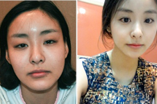 韩国灰姑娘和博朗温轮廓手术案例对比！