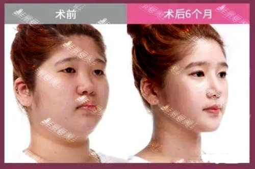 韩国巴诺巴奇整形医院朴钟林面部轮廓手术打造V字高级脸真人案例