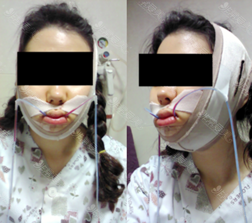 韩国爱宝整形医院尹奎植院长双鄂手术当天嘴里插着引流管