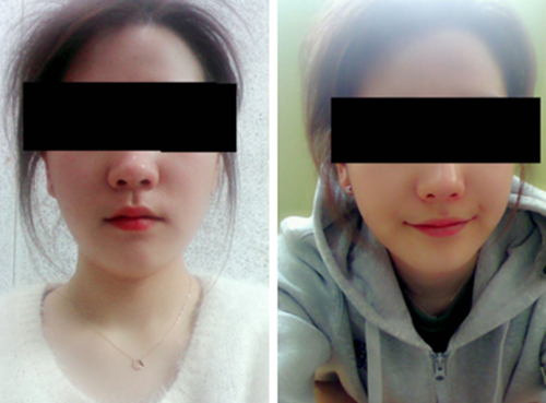 韩国爱宝整形医院尹奎植院长双鄂手术后1个月照片
