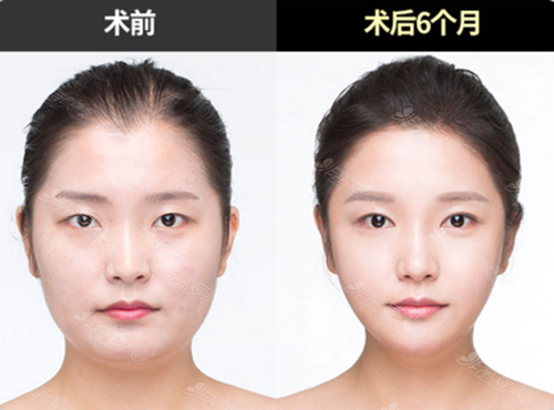 韩国巴诺巴奇整形医院朴钟林面部轮廓手术打造V字高级脸案例