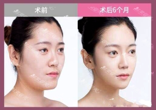韩国巴诺巴奇整形医院朴钟林面部轮廓手术打造V字高级脸案例对比