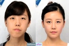 90后歪嘴女孩在韩国爱宝医院做双鄂手术后，变身元气美少女