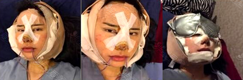 韩国欧佩拉整形外科权纯范院长面部轮廓术后第1天照片