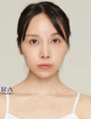 韩国OPERA整形外科-欧佩拉面部轮廓三件套真人案例