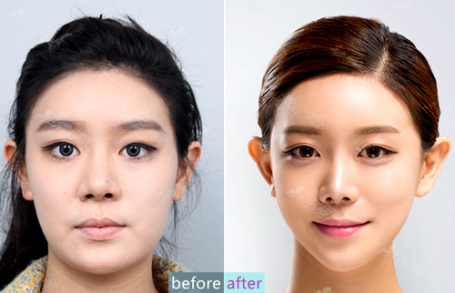 惊为天人的换脸术，韩国巴诺巴奇和DA整形医院哪家效果好？