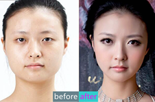 惊为天人的换脸术，韩国巴诺巴奇和DA整形医院哪家效果好？