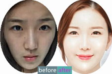 韩国芙莱思整形医院脂肪填充，凹陷苦瓜脸年轻10岁变萌妹