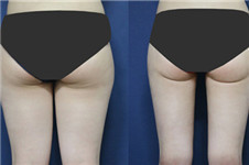 整容溶脂过程 附激光溶脂瘦腿前后的对比图