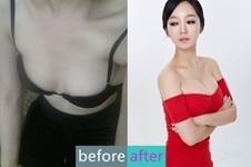 韩国赫尔希整形外科医院水滴假体隆胸，让你胸器逼人