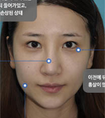 韩国碧夏整形医院隆鼻案例前后对比图_术前