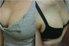 韩国ID隆胸案例：拥有柔软、高挺的美胸原来只需要三个月