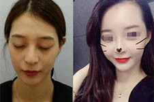 韩国宝士丽bocelle鼻综合怎样，为什么是耳鼻喉科医生手术？