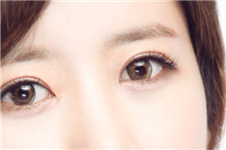 韩国芙莱思自然粘连埋线法双眼皮术后有疤痕吗？