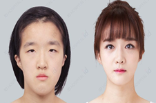 韩国菲斯莱茵和ID眼睛整形照片案例前后对比效果什么样？