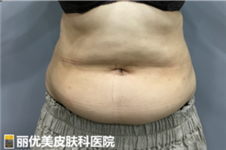 韩国丽优美皮肤科腹部迷你吸脂300毫升能瘦几斤